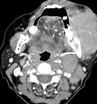 CT SCAN OF FACE /NECK